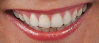 Strahlend weiße Zähne